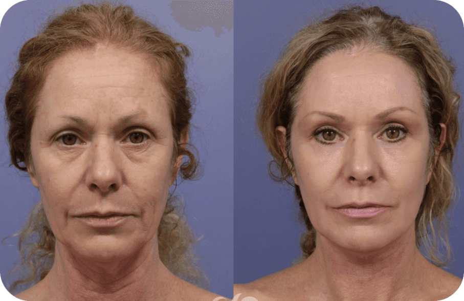 synevra ultralift official website